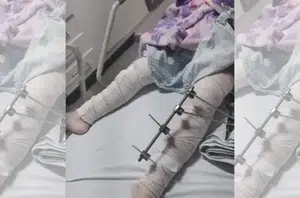 Médicos se confundem e operam perna errada de menina de 6 anos(Reprodução)