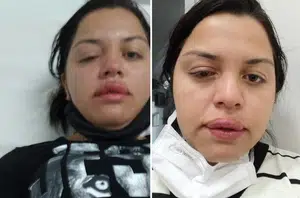 Francieli Priscila foi atingida por líquido no rosto está com o rosto e o olho machucados(Arquivo pessoal)