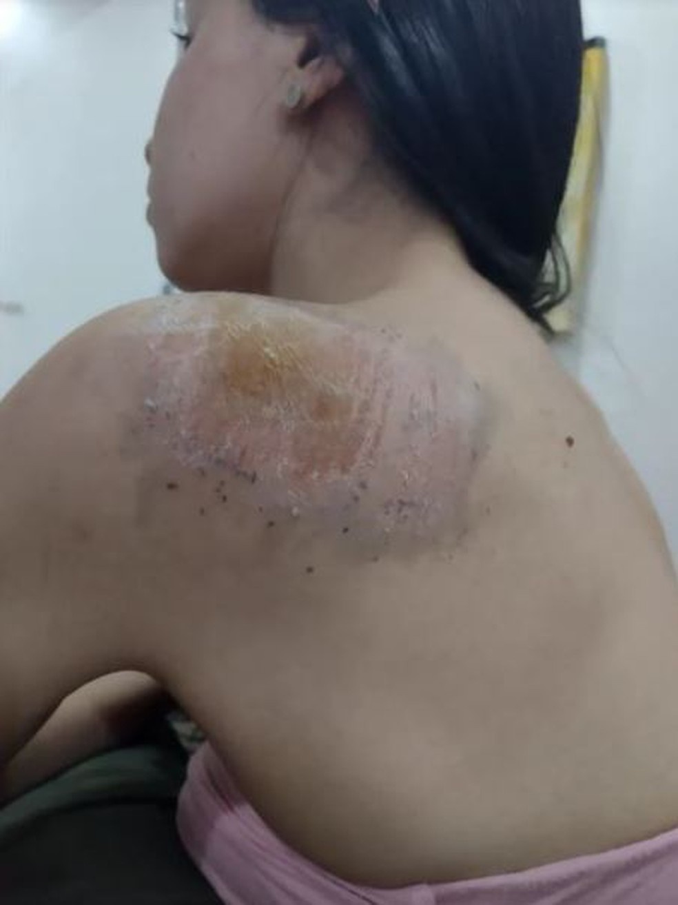 Andressa ficou com ralados pelo corpo após cair da bicicleta, em Palmas