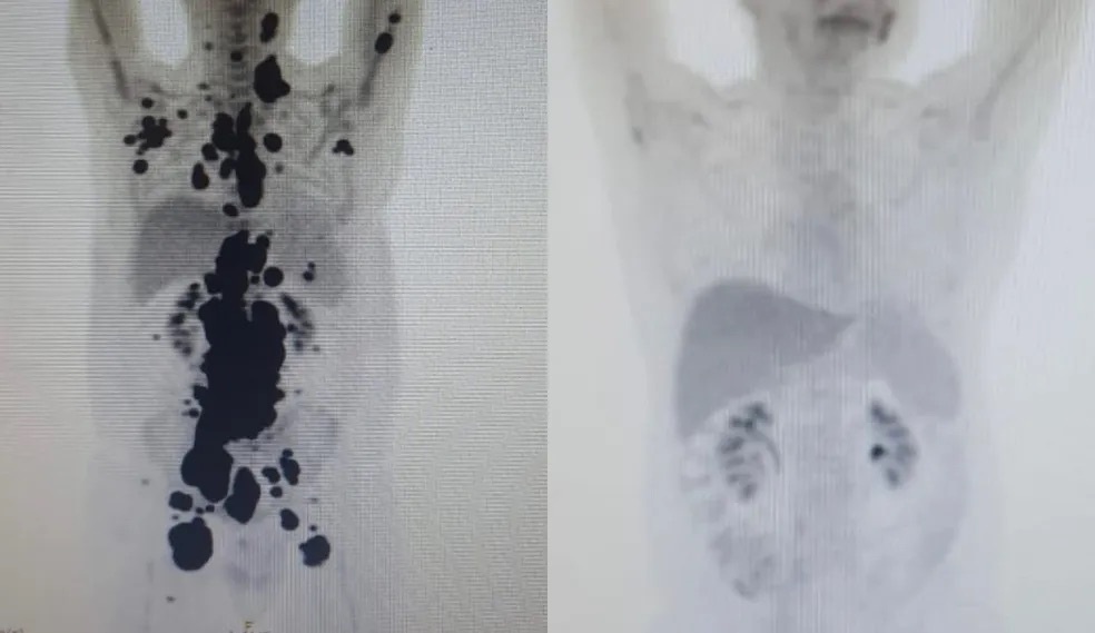 Exames mostram antes e depois de câncer de paciente; à direita, imagem mostra remissão da doença.