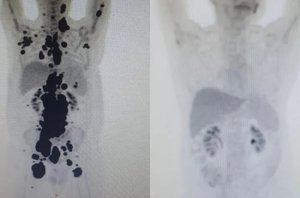 Exames mostram antes e depois de câncer de paciente; à direita, imagem mostra remissão da doença.(Reprodução/dcm)