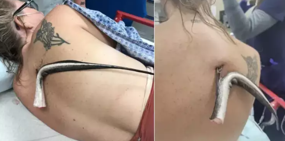Banhista é ferida por ferrão de arraia nas costas durante lazer em praia