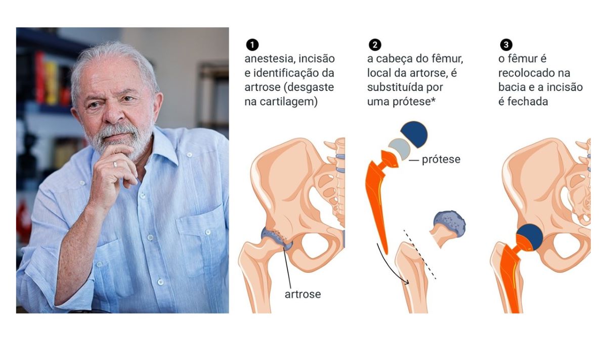 A cirurgia de Lula. Saiba de todos os detalhes aqui