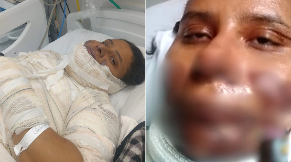 A mulher teve queimaduras pelo corpo após acidente com óleo quente