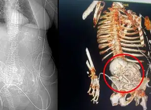 Mulher descobre feto calcificado por mais de 50 anos