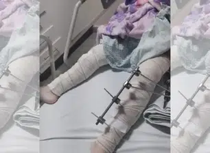 Médicos se confundem e operam perna errada de menina de 6 anos