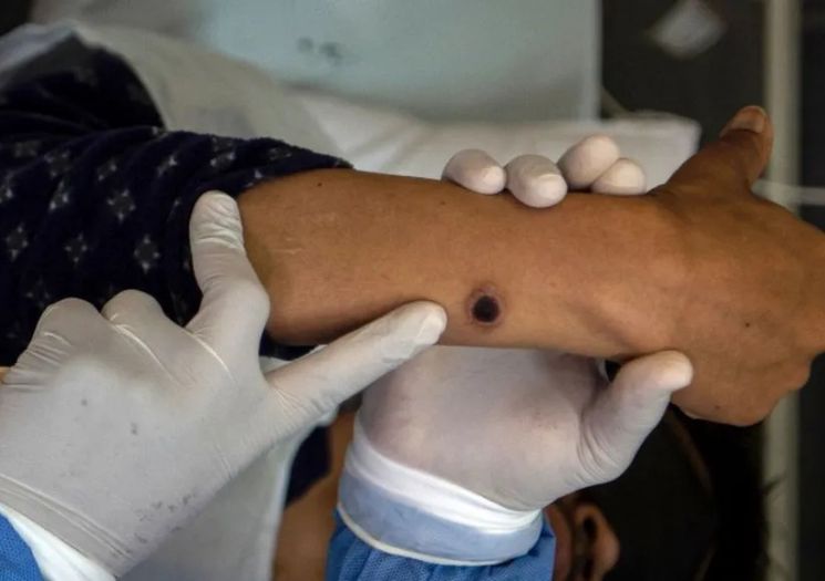 SP confirma primeiro caso da nova cepa do vírus Mpox