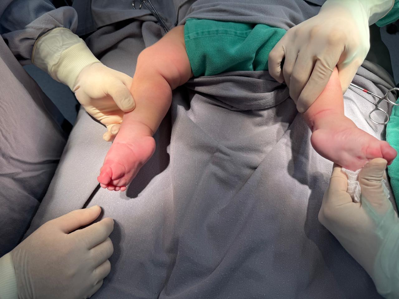 Programa Pé Torto Congênito é referência no tratamento realizado em crianças no Hospital Infantil
