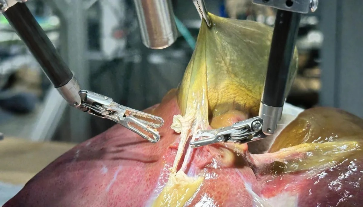 Robô com IA realiza 1ª cirurgia autônoma em humanos