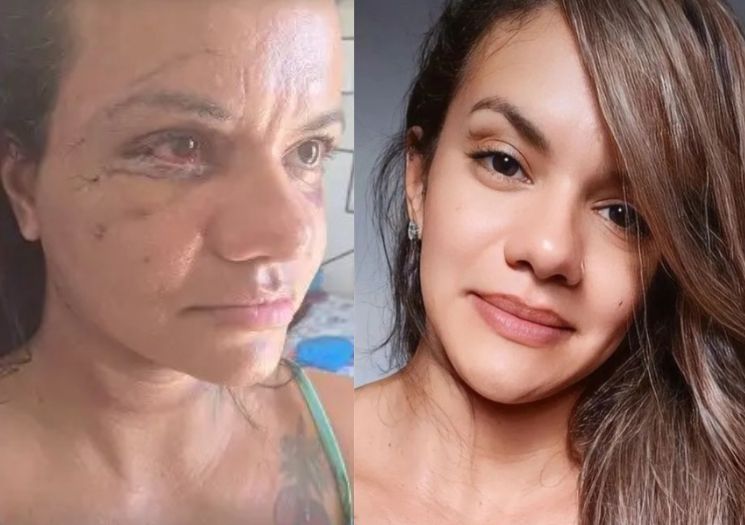 Mulher que levou 61 socos de bolsonarista mostra rosto após cirurgia