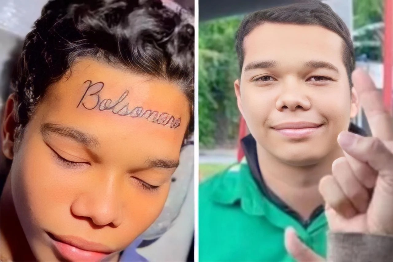 Jovem tatuou “Bolsonaro” na testa. Se arrependeu e agora está com o rosto limpo