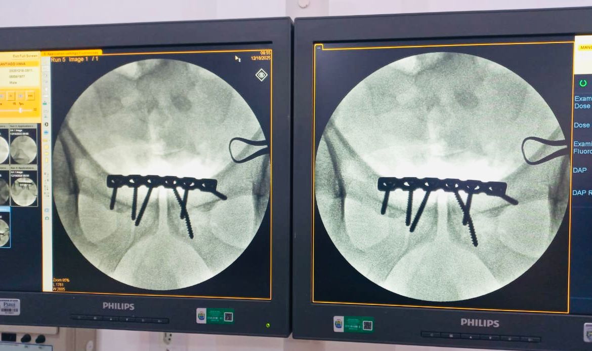 Hospital de Piripiri realiza, pela primeira vez, cirurgia ortopédica de alta complexidade em paciente com fratura de bacia
