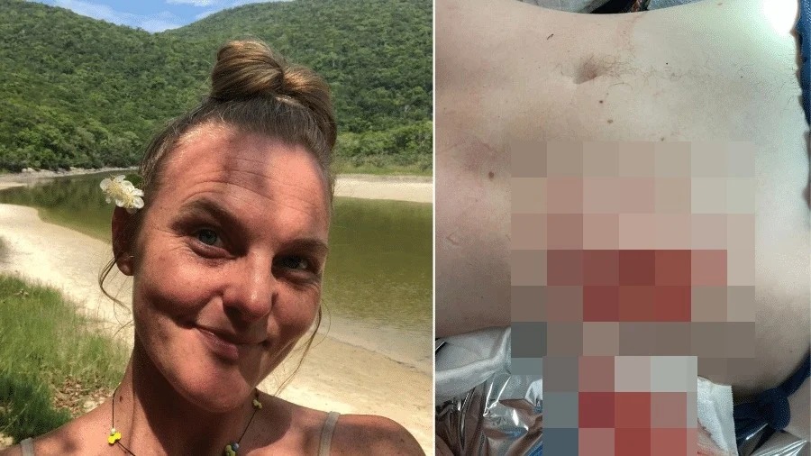 Mulher é atacada por capivara e tem parte da nádega arrancada