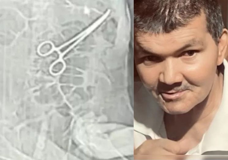 Médicos esquecem pinça dentro do paciente e ele morre em MG