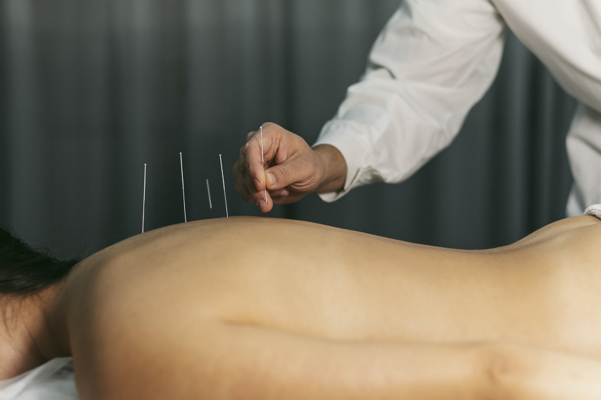 Lei regulamenta exercício profissional da acupuntura