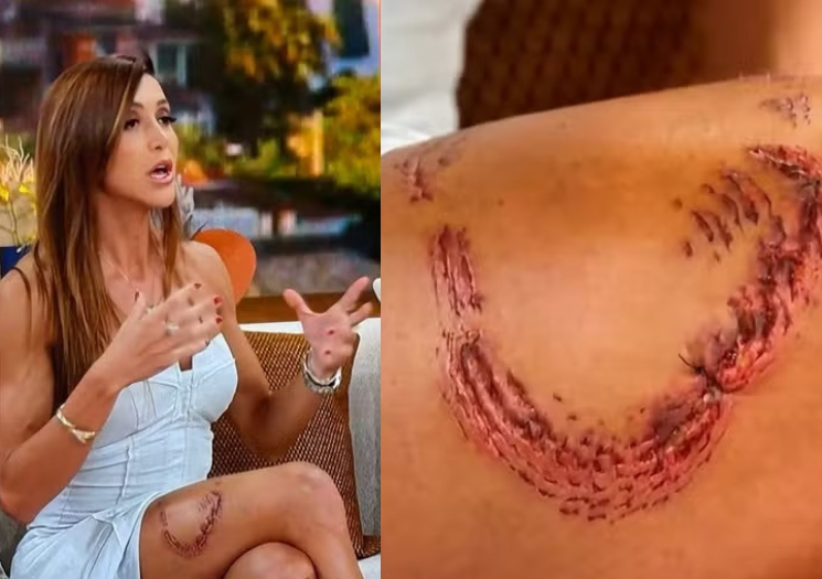 Turista mordida por tubarão em Noronha mostra marcas na coxa