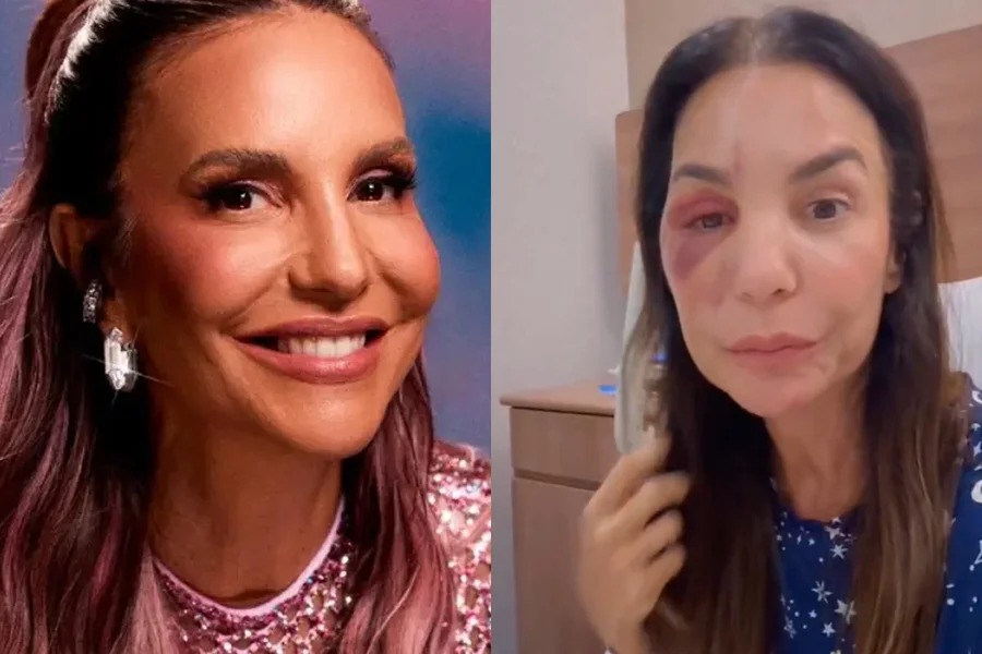 Ivete Sangalo passa por cirurgia delicada na mandíbula