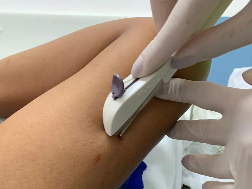 Piauí oferece implantes contraceptivos para mulheres