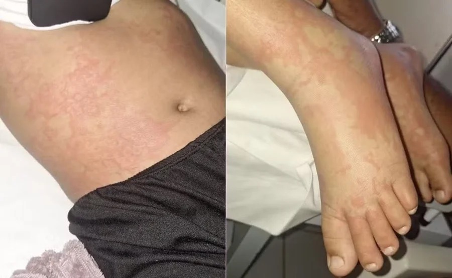 A criança de 10 anos que luta contra infecção após contato com detergente Ypê