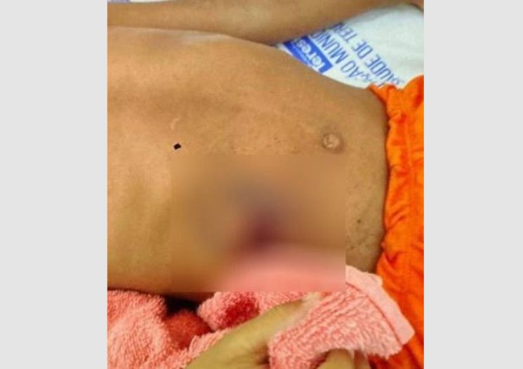 Criança de 4 anos é baleada por outra durante brincadeira com arma em Nazária